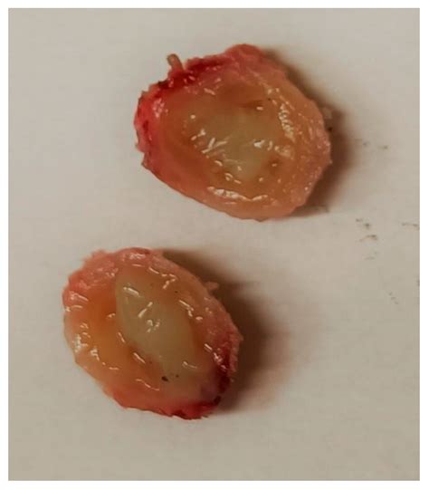 Dirofilaria repens in the Spermatic Cord of a 5-Year-Old Boy: A Rare ...