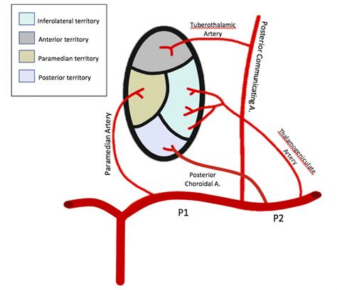 Stroke masquerading as cardiac arrest: the artery of Percheron | BMJ Case Reports