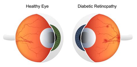 Diabetes: Diabetic Retinopathy Stages