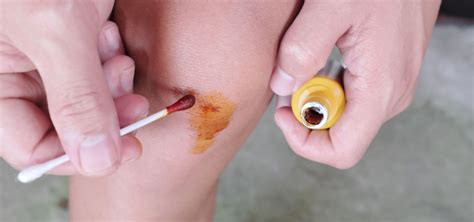 The Uses of Povidone-Iodine Ointment USP: A Comprehensive Guide