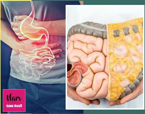 कोलन इंफेक्‍शन से बचाएंगे ये 7 फूड, पेट के सारे रोग हो जाएंगे दूर ...