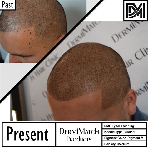 Hair Loss and Dry Scalp - DermiMatch Hair Clinic | Scalp ...