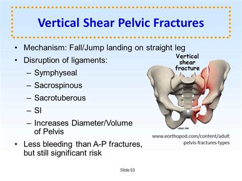 Image result for Pelvic Spring Test