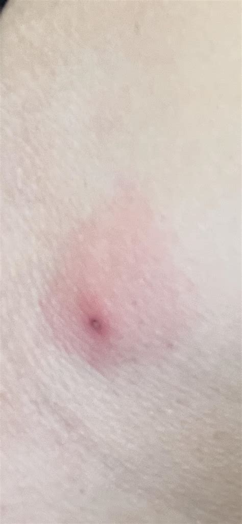 Spider bite? : r/spiderbites