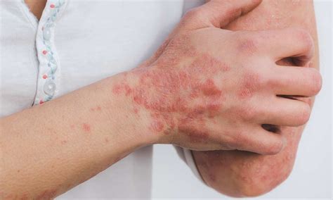 Linoleic acid linked with hypersensitivity to temperature and pain in ...