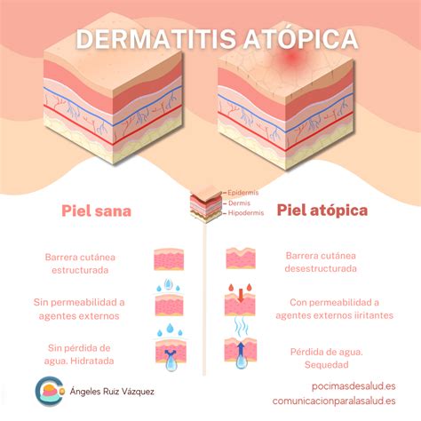 Dermatititis atópica: Causas, síntomas y tratamientos que debes conocer ...
