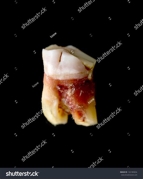 Image result for Pulled Tooth