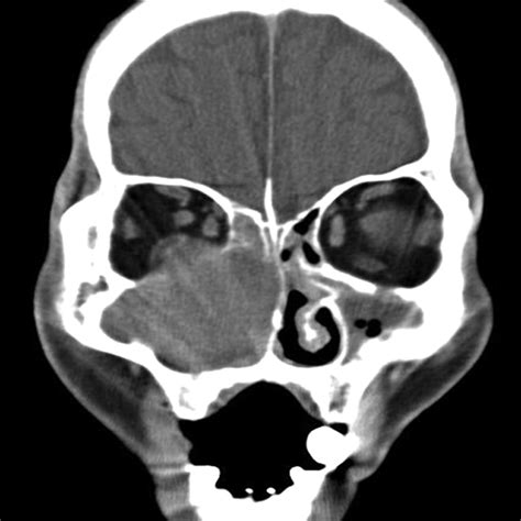 Organized Hematoma of the Maxillary Sinus: CT Findings | AJR