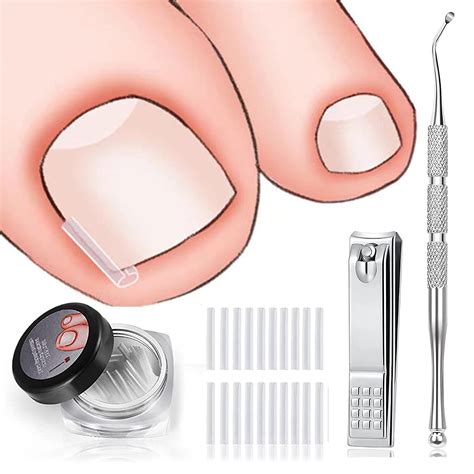 Amazon.com: Ingrown Toenail Treatment Includes 60 PCS of Ingrown Toenail Corrector Strips ...