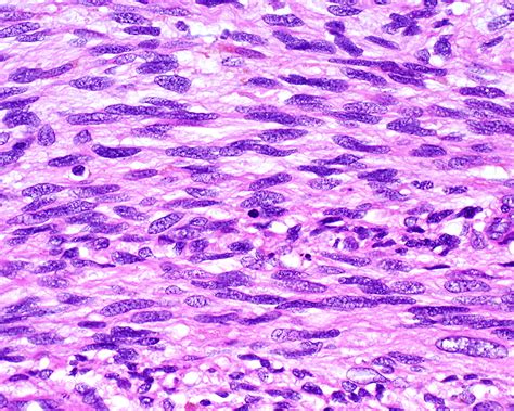 Keytruda Spindle Cell Sarcoma at Ryan Knight blog