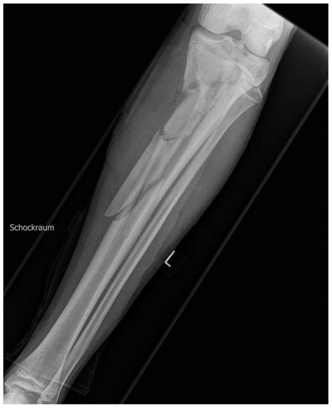 Simultaneous Free Fibula and Anterolateral Thigh Flap in Lower ...