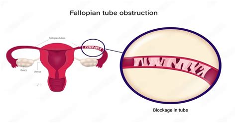 Image result for Fallopian Tube Surgery