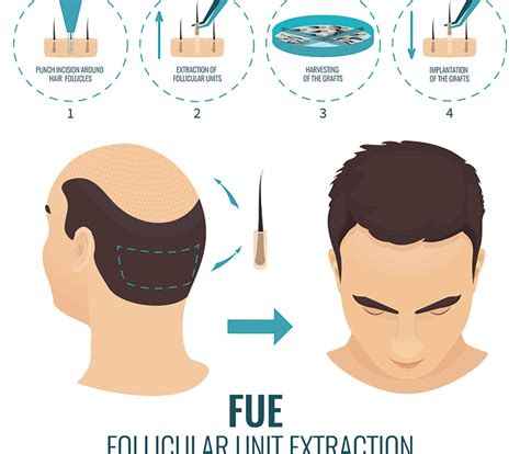 FUE Hair Transplants: How Long to See Results - Miami Hair Institute