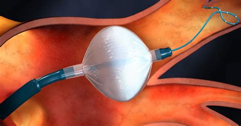 Three Studies Support Medtronic’s Cryoablation Systems As ‘First Line ...
