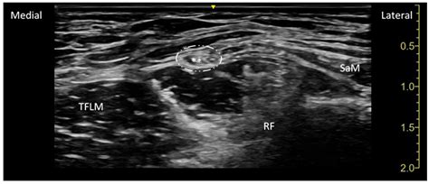 Pericapsular Nerve Group (PENG) Associated with Lateral Femoral ...