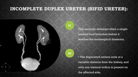 Duplex renal systemComplete/Partial Duplex Renal System, .pptx