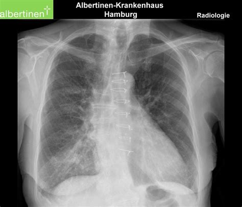 X-ray of the thorax: Aspiration pneumonia - DocCheck