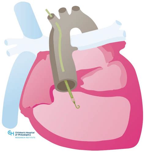 Durable Mechanical Circulatory Support in Adult Congenital Heart ...