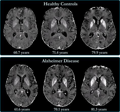 Cross-sectional and Longitudinal Assessment of Brain Iron Level in Alzheimer Disease Using 3-T ...