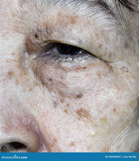 Small Brown Patches Called Age Spots on Face of Asian Elder Woman. they are Also Called Liver ...