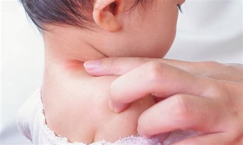 5 ways to manage childhood allergies