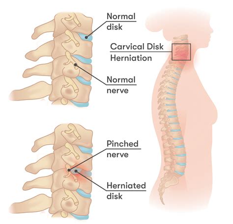 Is Your Shoulder Pain due to a Pinched Nerve? - Injurymap