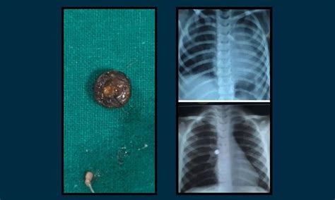 Doctors Remove Button Battery Stuck in 4-year-old’s Bronchus