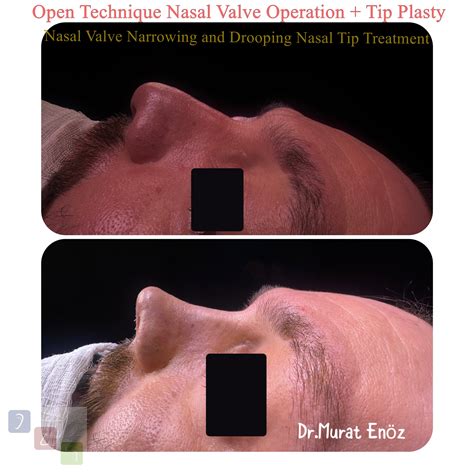Nasal Valve Collapse and Treatment