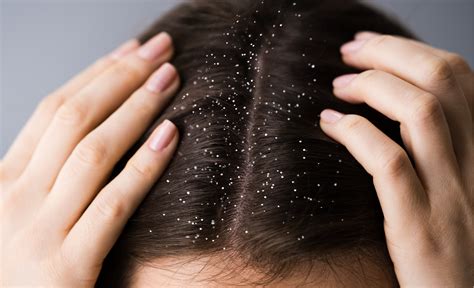 5 Effective Tips to get rid of Dandruff in monsoon – Sesa Care