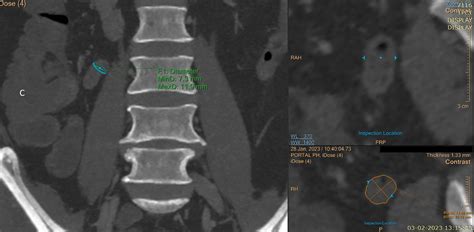 Image result for Normal Looking Appendix