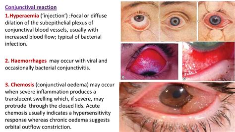 anatomy of conjunctiva. Ophthalmology slides | PPTX