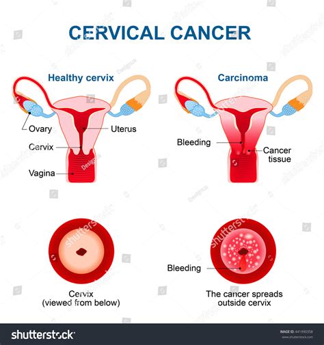 Cervical Cancer. Malignant Neoplasm Arising From Cells In The Cervix ...