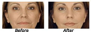 Dr. Goutam Guha - Botox Treatment : Kolkata, Wrinkle Filling Implants ...