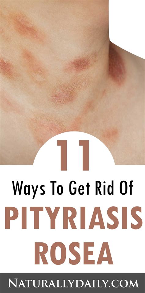 Pityriasis Rosea Pictures Causes Symptoms Treatment