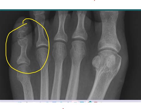 Understanding Nondisplaced Fracture How To Diagnose A - vrogue.co