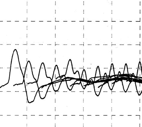 Image result for Repetitive Nerve Stimulation Test