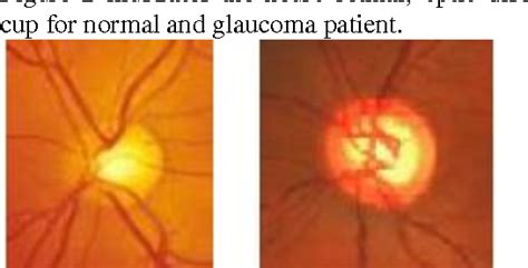 Figure 2 from Analysis Of Cdr Detection For Glaucoma Diagnosis ...