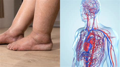 Image result for Blood Circulation Problems