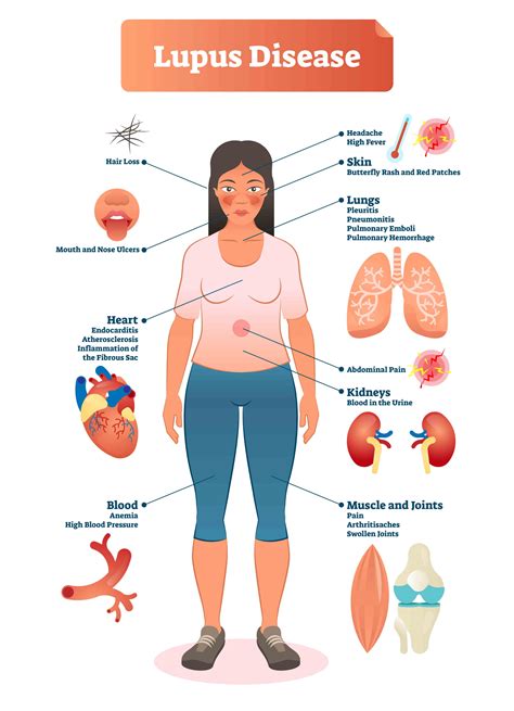 Lupus Side Effects Scientists Have Finally Discovered The Cause Of