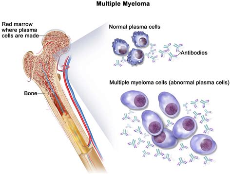 Myeloma - Multiple Myeloma - Causes, Symptoms, Stages, Prognosis
