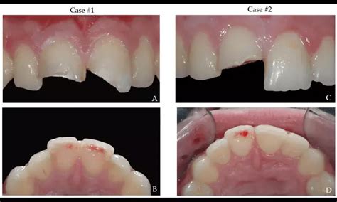 Transparent Crown with Pulpotomy Improves Outcomes in Traumatic Primary ...