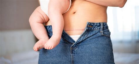 Postpartum Swelling: Causes, Symptoms, and Treatments