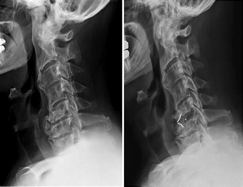 Anterior Longitudinal Ligament Calcification