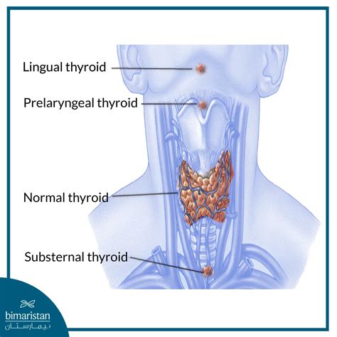 Thyroglossal Duct Cyst: What It Is & Surgical Removal Guide