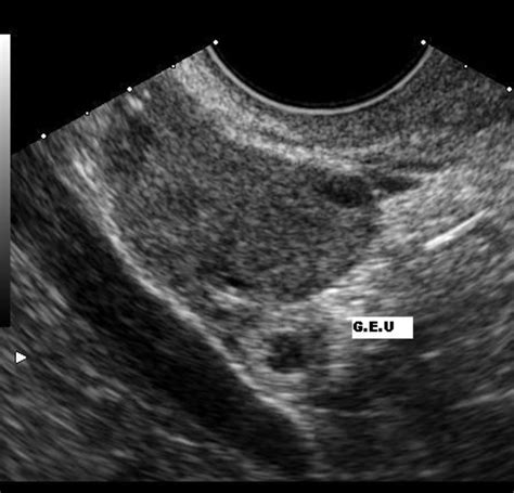 Abdominal Ectopic Pregnancy Ultrasound