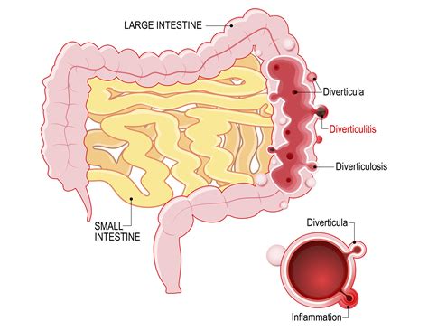 How I Cured My Diverticulitis Journey