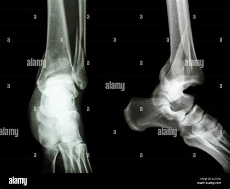 film x-ray ankle AP/Lateral : show fracture distal tibia and fibula ...