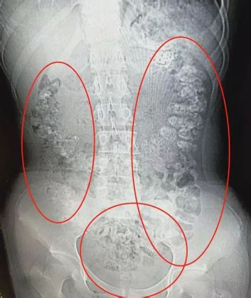 CT scan detects 100 undigested tapioca pearls in teen's abdomen: Case ...