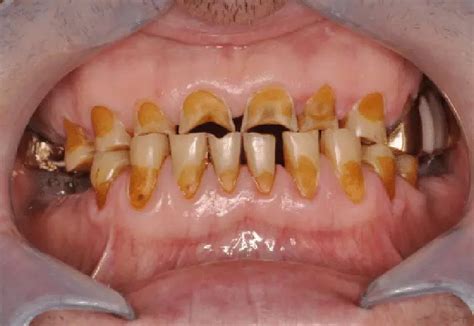 Gastroesophageal reflux disease and dietary habits linked to erosive ...