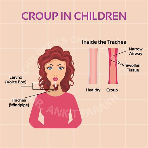Croup Cough